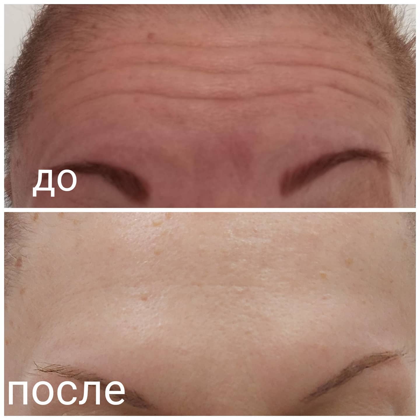 Botox до и после